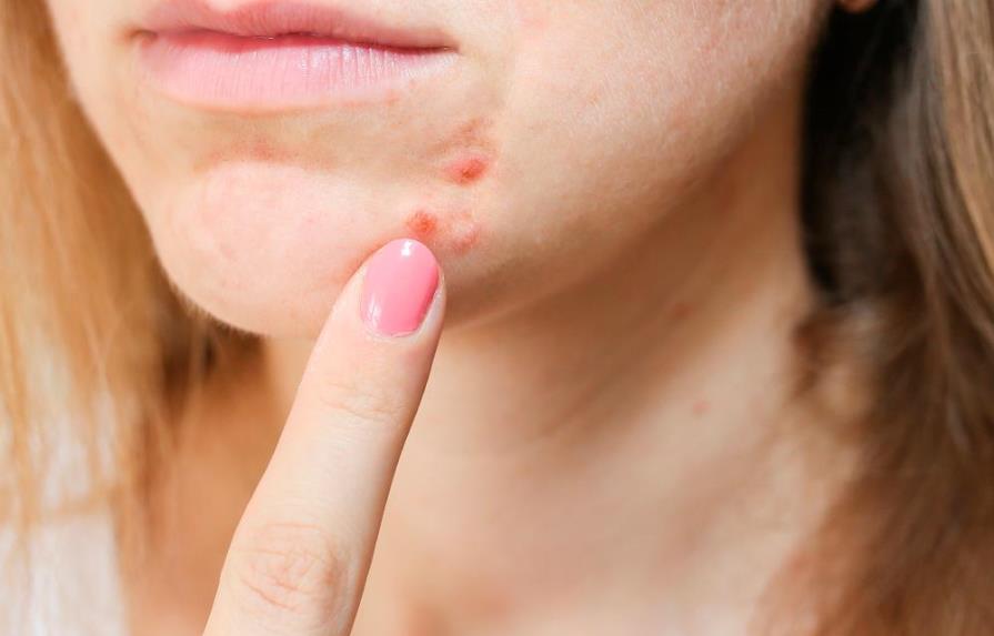 Remedios caseros para quitar las cicatrices del acné
