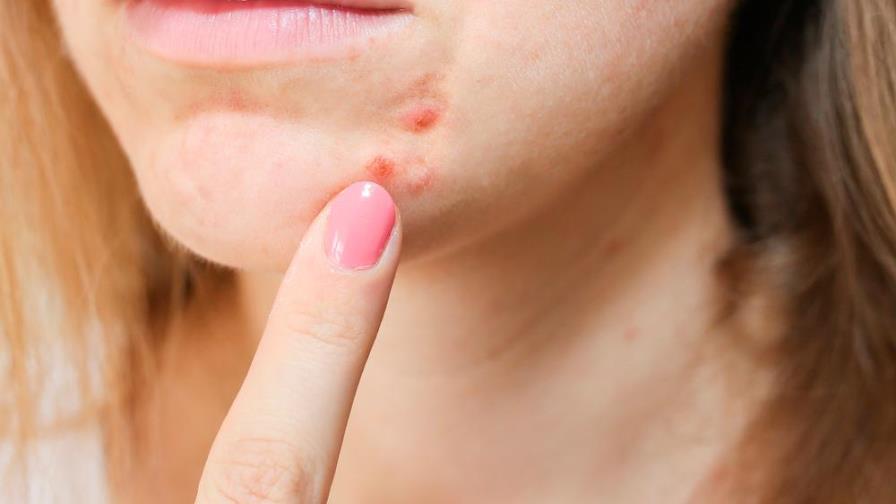 Remedios caseros para quitar las cicatrices del acné