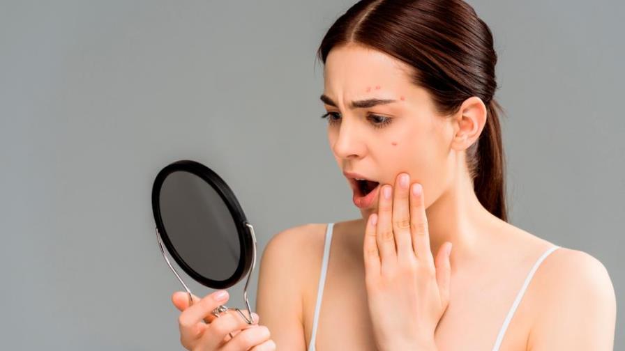 Esto debes hacer para evitar la aparición de acné durante la cuarentena