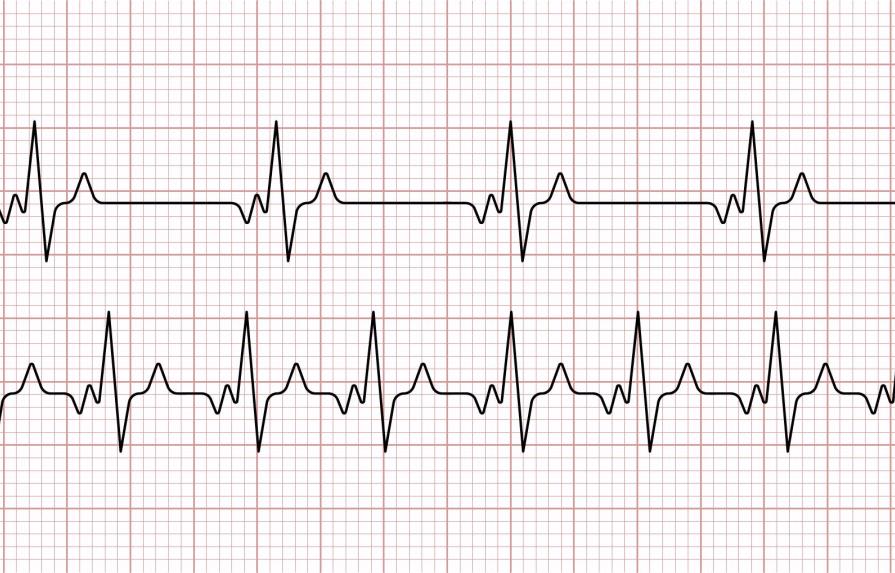 Pandemia por COVID-19 ha incrementado casos de cardiomiopatía