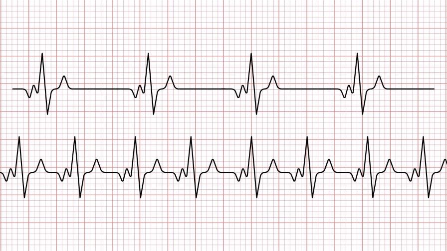 Pandemia por COVID-19 ha incrementado casos de cardiomiopatía Pandemia por COVID-19 ha incrementado casos de cardiomiopatía