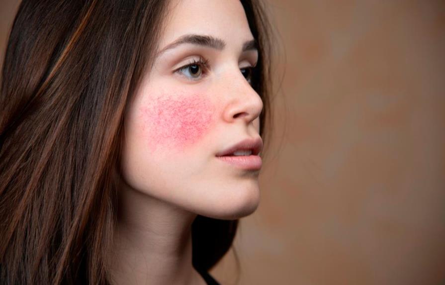 ¿Cuáles son los factores que activan la piel rosácea?