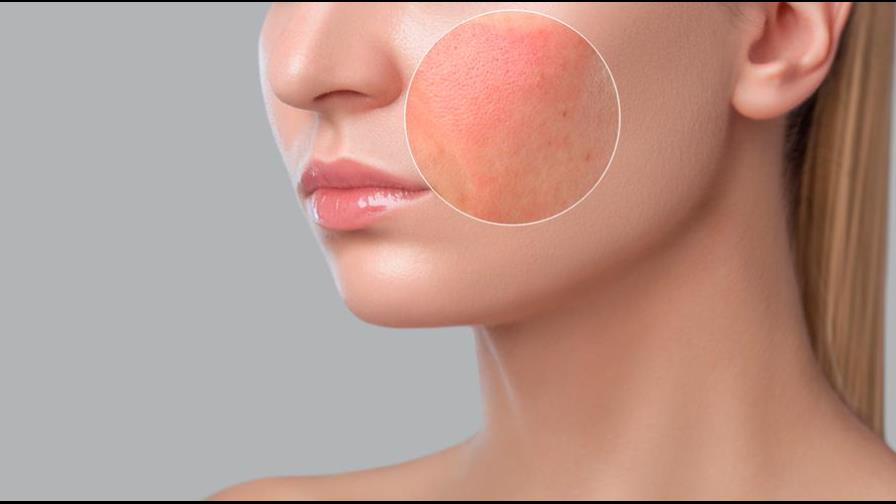 ¿Tienes piel grasa? errores que debes evitar