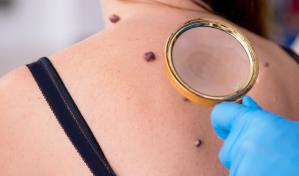 Conoce el melanoma, un c&aacute;ncer de la piel que puedes evitar