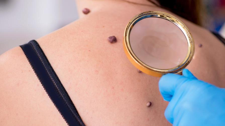 Conoce el melanoma, un cáncer de la piel que puedes evitar