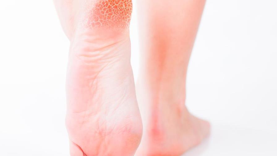 Hongos en la piel: síntomas, causas y qué hacer