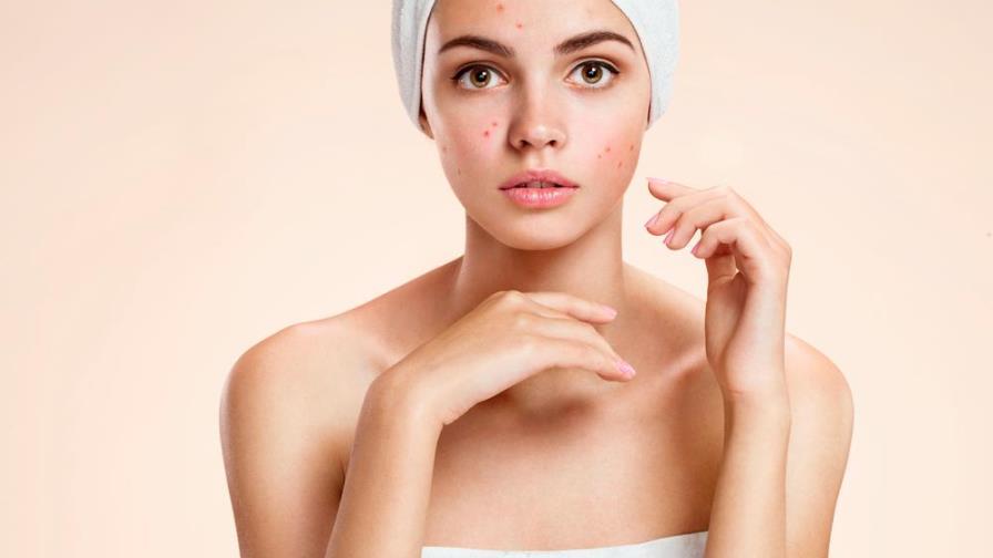 Acné hormonal, ¿podemos deshacernos de sus brotes?