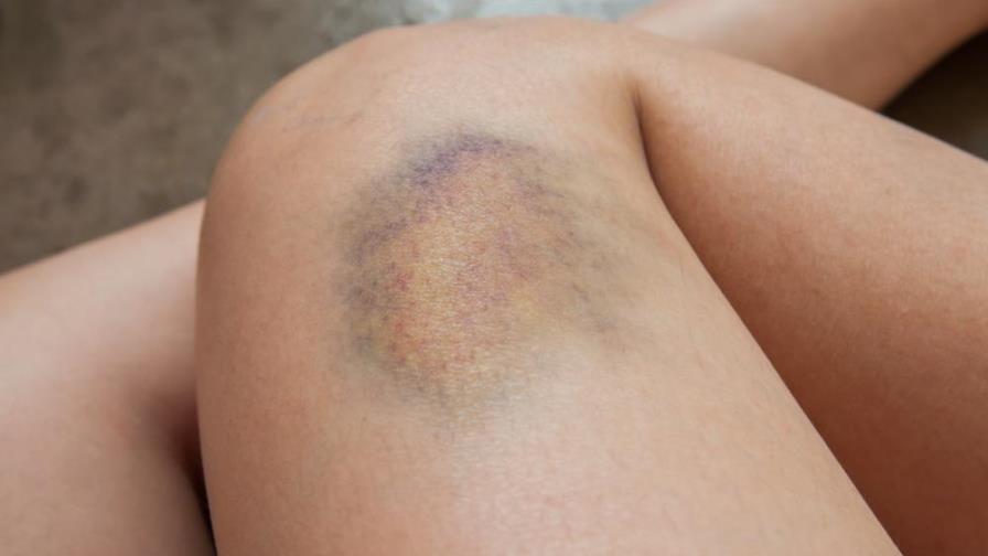 Hematomas ¿por qué podrían aparecer frecuentemente?