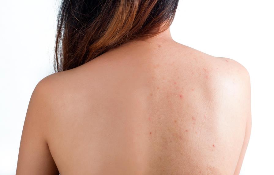 7 consejos para tratar el acné en la espalda