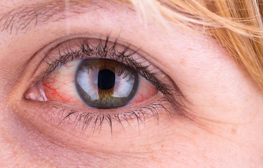 Tratamientos caseros para tratar la irritación en los ojos