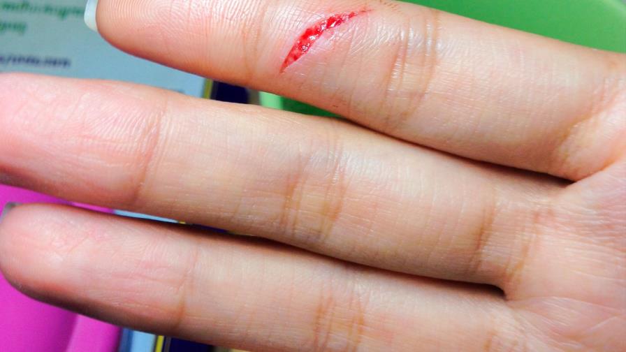 ¿Cómo influye tu alimentación en la cicatrización de heridas?