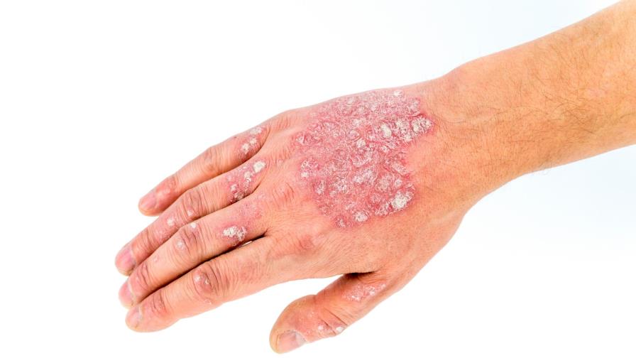 Psoriasis, ¿alguna intervención nutricional?