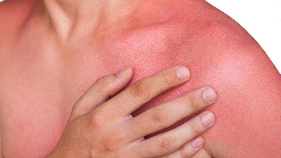 Consejos para prevenir y curar quemaduras solares