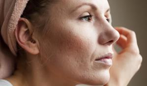 Cómo combatir el acné hormonal
