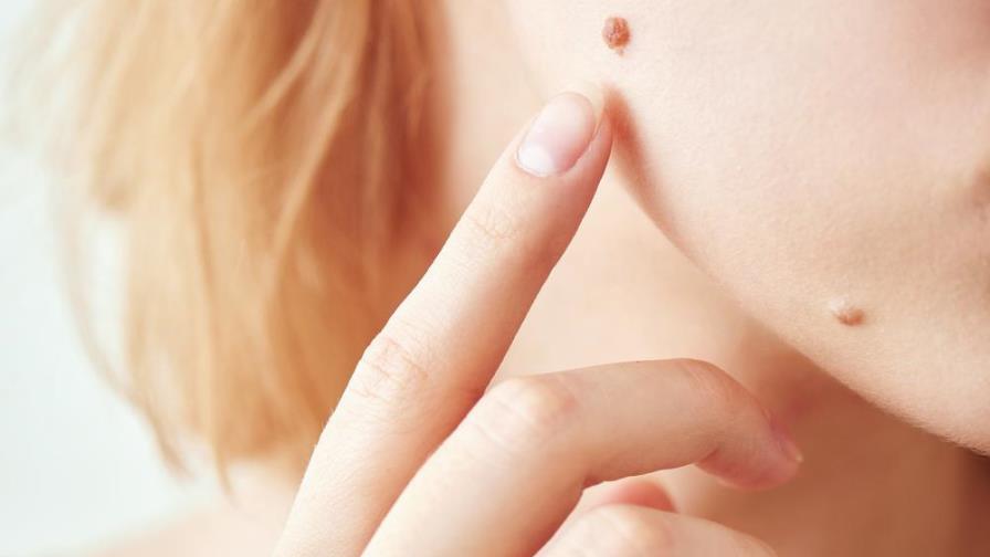 Pecas y lunares, ¿conoces la diferencia?