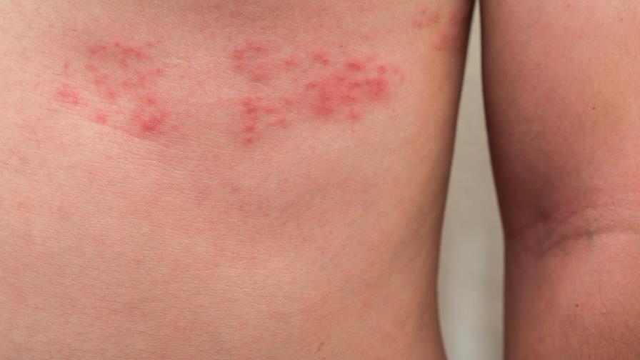 Herpes zoster o culebrilla