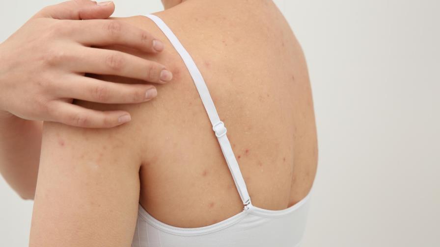 Por qué tienes acné en la espalda y cómo combatirlo