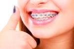 Precauciones a tomar para el sexo oral con brackets