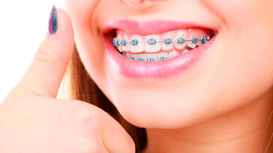 Precauciones a tomar para el sexo oral con brackets