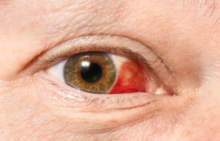 Estos son los motivos por los que podrías tener un derrame ocular