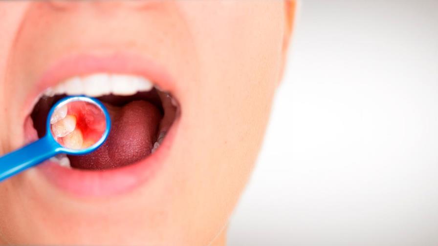 Las enfermedades bucales son un riesgo para pacientes con hemofilia