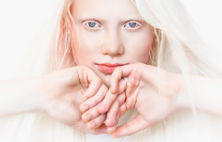 ¿Qué es el albinismo? y cómo podemos ayudar 