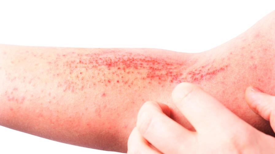 Dermatitis atópica: trastornos a flor de piel 