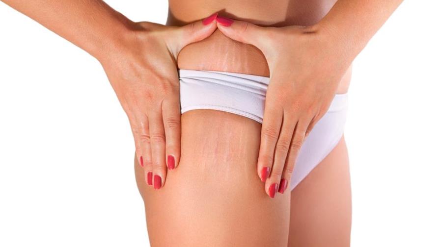 Tratamientos caseros para combatir las estrías Tratamientos caseros para combatir las estrías