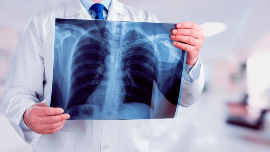 Casos de tuberculosis mantienen caída pero preocupa el impacto de la pandemia
