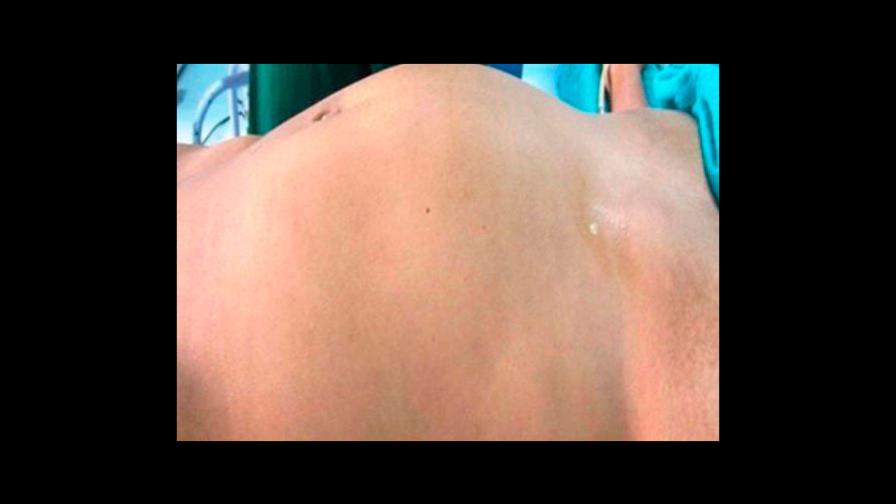 Joven descubre que bulto de su abdomen es el feto malformado de su hermano gemelo Joven descubre que bulto de su abdomen es el feto malformado de su hermano gemelo