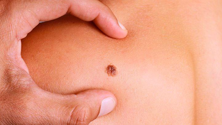 Los prebióticos activan la capacidad del sistema inmune contra el cáncer de piel 