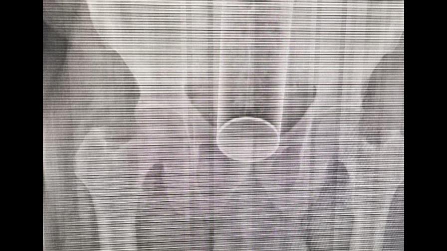 Se le aloja frasco de insecticida en el recto mientras sostenía relaciones con su esposa 