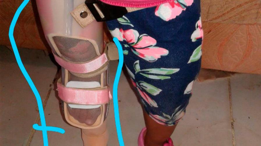 Madre pide ayuda para comprar prótesis a su hija de tres años