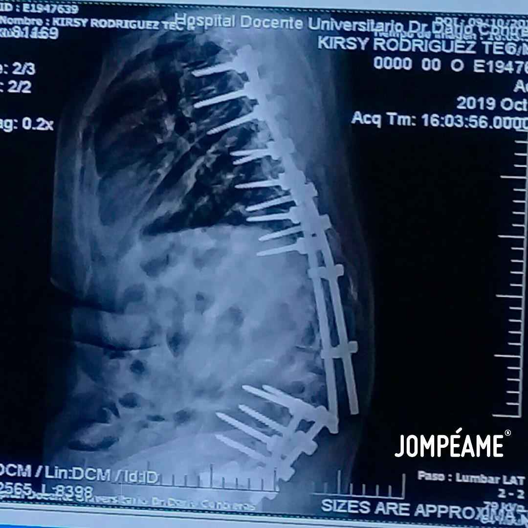Radiografía en la que se muestra la fractura de la joven.