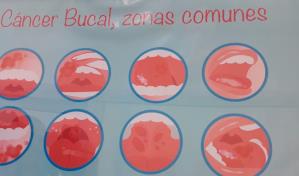 El cáncer bucal vinculado al Virus del Papiloma Humano se incrementa en el país 
