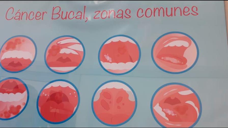 El cáncer bucal vinculado al Virus del Papiloma Humano se incrementa en el país El cáncer bucal vinculado al Virus del Papiloma Humano se incrementa en el país