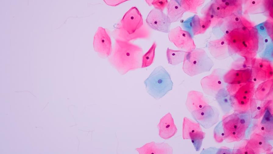 Una prueba casera para la detección del cáncer de cuello uterino, ¿es esto posible? Una prueba casera para la detección del cáncer de cuello uterino, ¿es esto posible?