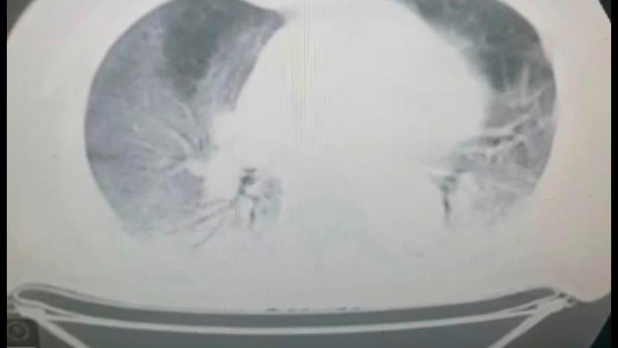 El 88 % de los ingresados por COVID-19 no tiene la vacuna, según ministro de Salud 