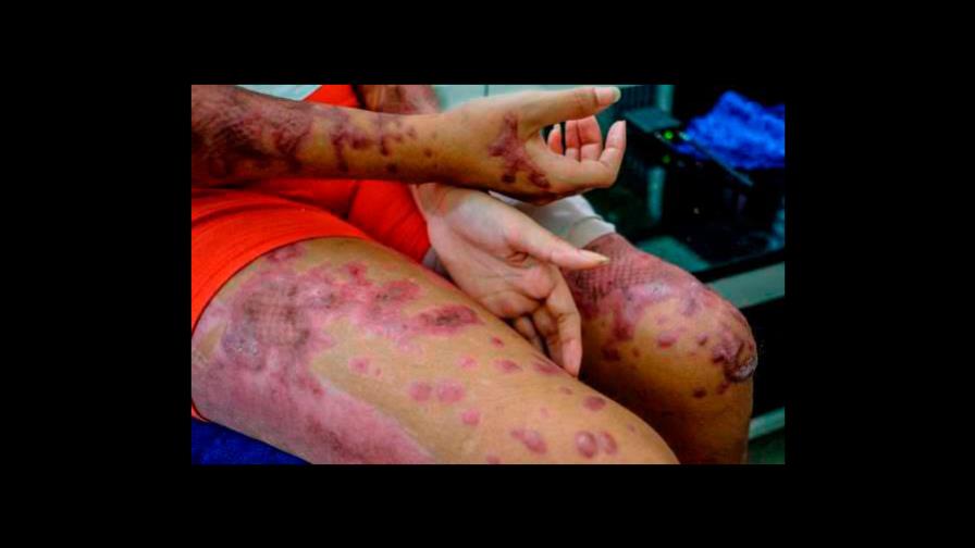 Tribunal ordena tomar por adelantado testimonio de Yocairi para que se someta a cirugía reconstructiva Tribunal ordena tomar por adelantado testimonio de Yocairi para que se someta a cirugía reconstructiva