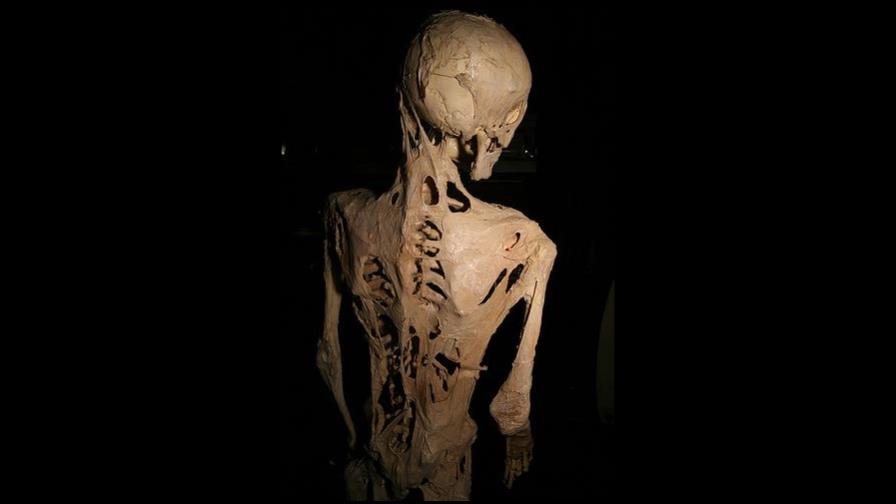 Un paso más cerca del tratamiento del síndrome del hombre de piedra