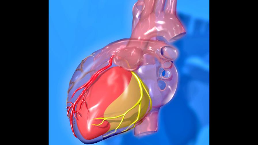 Hallan 10 nuevas características genéticas asociadas al infarto de miocardio