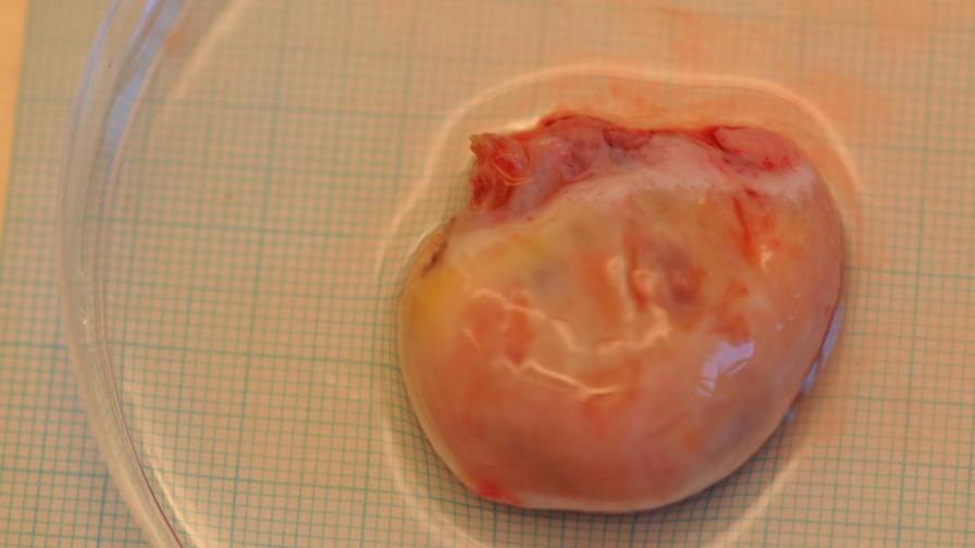 Trasplante de ovario ayuda a algunas mujeres a tener bebés 