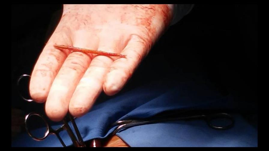 Extraen un palillo de dientes del corazón de un hombre en Argentina