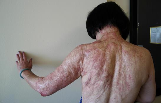 “La niña del napalm” busca alivio 40 años después