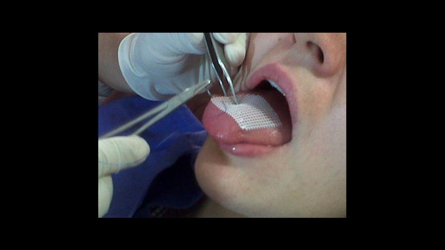 Alertan sobre riesgo de usar malla lingual para adelgazar Alertan sobre riesgo de usar malla lingual para adelgazar