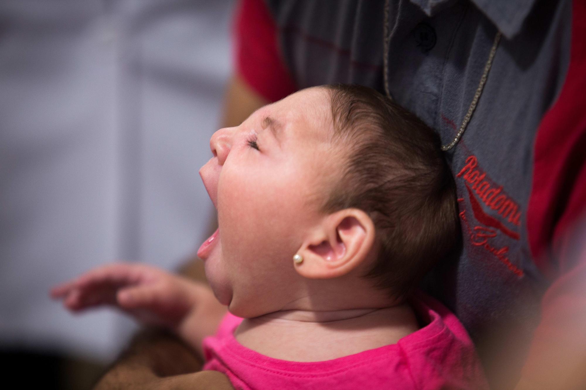 Niño microcefálico
