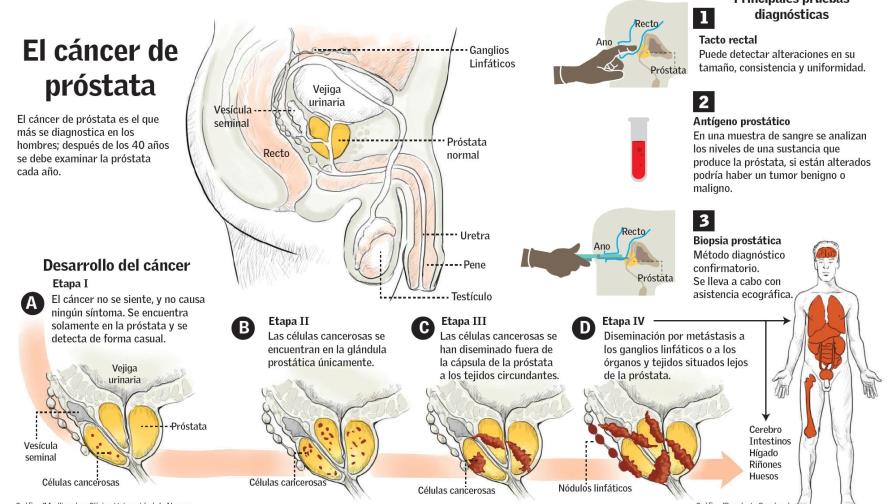 Cáncer de próstata, el enemigo silente del hombre