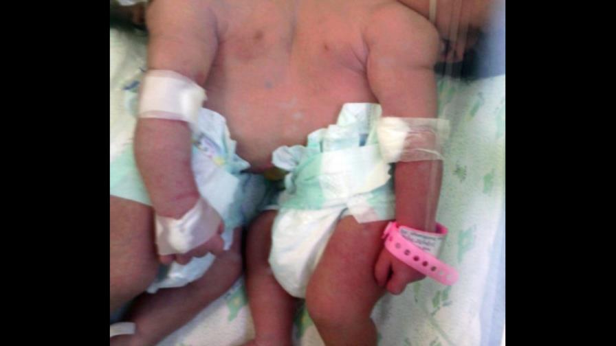 ¿Cómo se forman genéticamente los siameses?