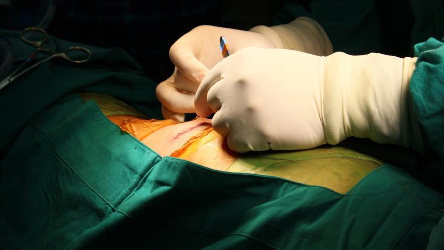 Liposucción: mitos y verdades