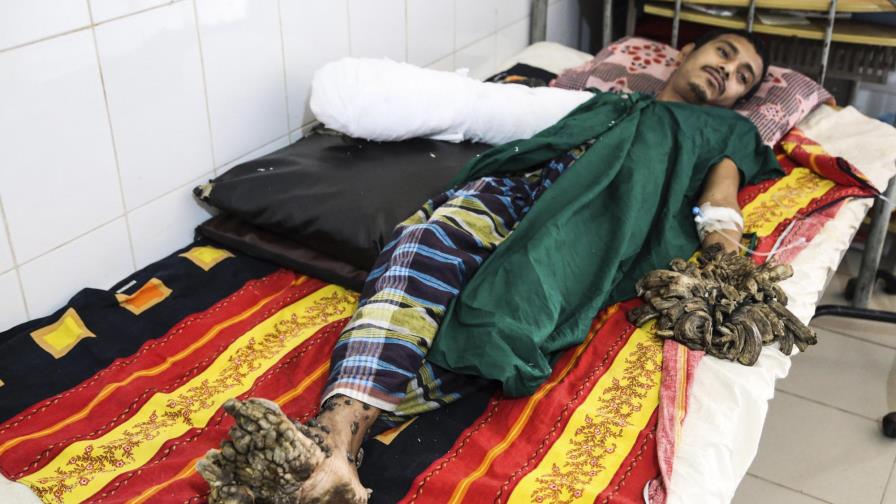 El “hombre árbol” de Bangladesh quiere “volver a tener una vida normal” tras ser operado El “hombre árbol” de Bangladesh quiere “volver a tener una vida normal” tras ser operado